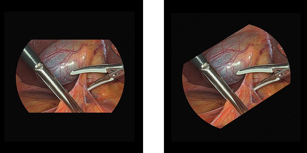 Side by side image comparing original image from endoscope and rotation correction image with horizon re-set