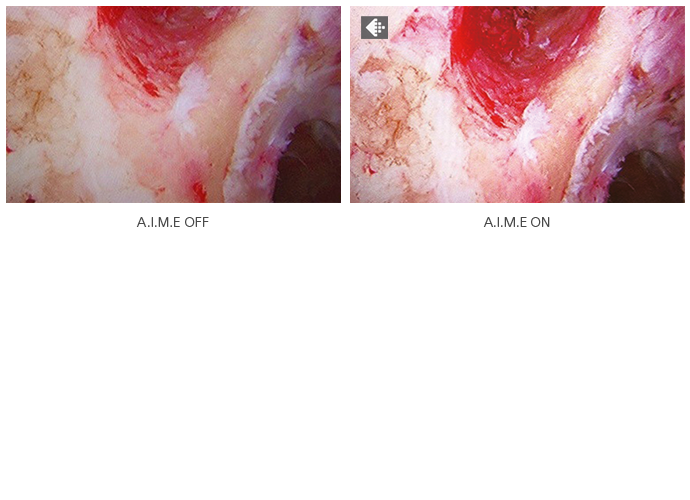 A comparison of two surgical images where advanced A.I.M.E. technology is on and off.