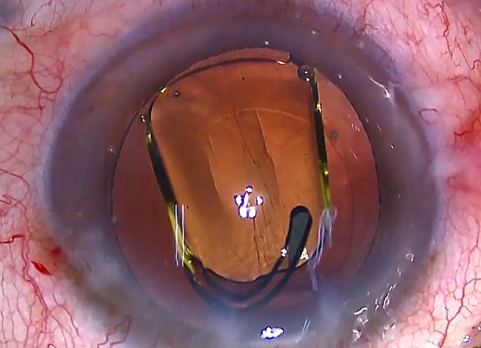 Eye-surgery footage showing how our HDR camera is enhancing the dark areas of the eye