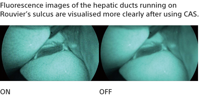 HD endoscopic images of the liver with CAS turned on and off