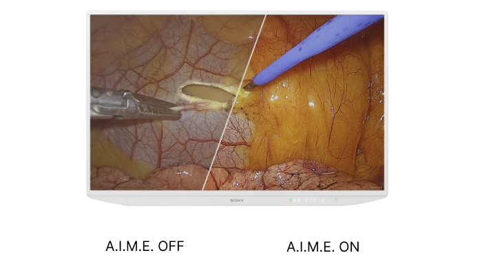 Two comparison surgical image with A.I.M.E. on and off. The image part with A.I.M.E. on has better sharpness and contrast.