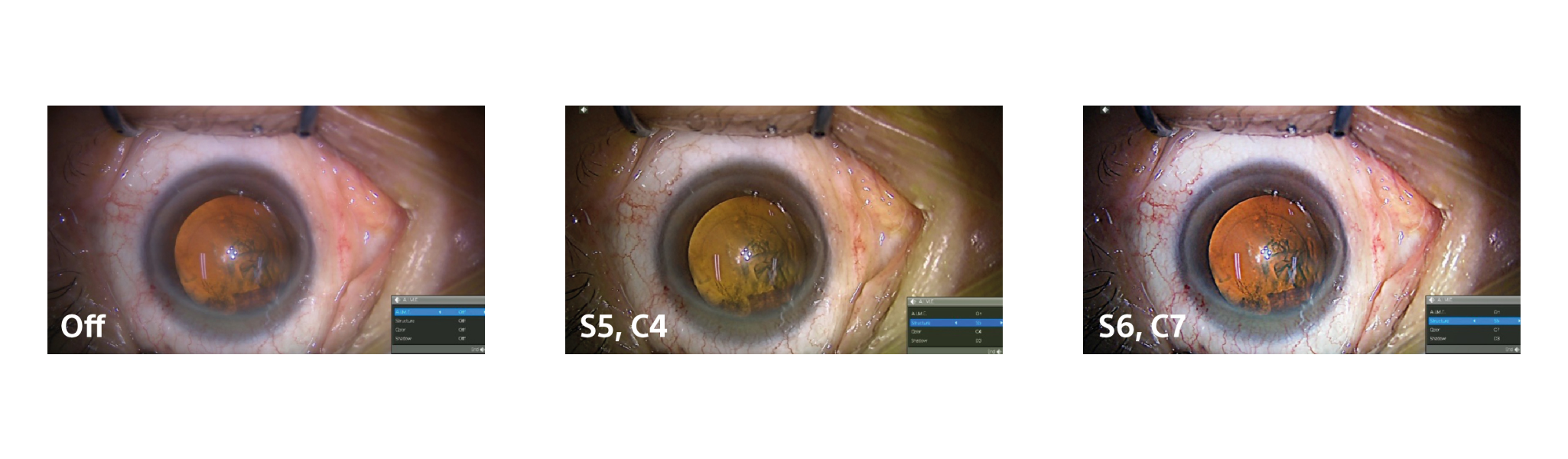 Three image of eye showing the different settings of the Colour Enhancement function